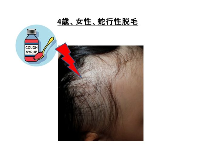 円形脱毛症　病院
